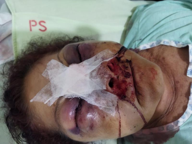 Mulher fica com rosto desfigurado após agressões de ex-companheiro em Barra da Estiva